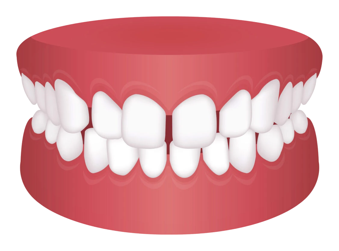 Teeth Spacing